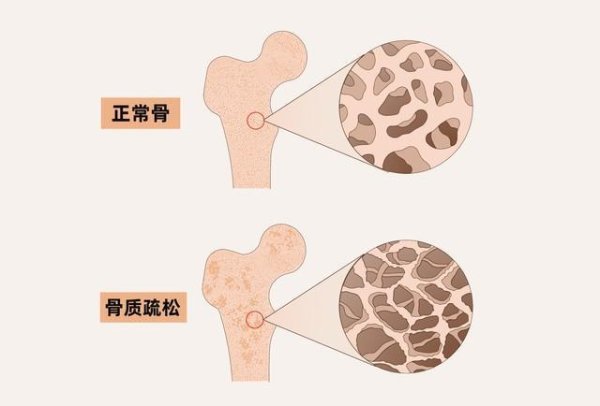 人有没有骨质疏松，看手就知道？手上这2个信号，早发现早干预